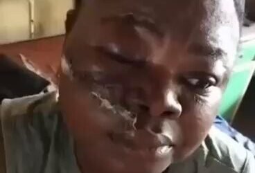 Police Tear Gas Canister Hits APC Women Leader, Leaves Her With Severe Facial Injuries