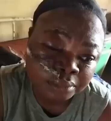 Police Tear Gas Canister Hits APC Women Leader, Leaves Her With Severe Facial Injuries