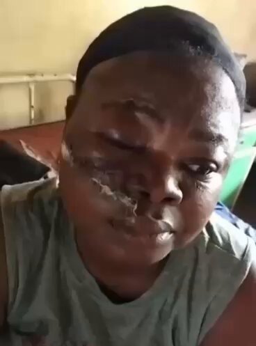 Police Tear Gas Canister Hits APC Women Leader, Leaves Her With Severe Facial Injuries
